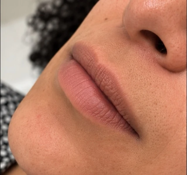 Região labial antes, em close lateral: lábios, nariz e queixo.