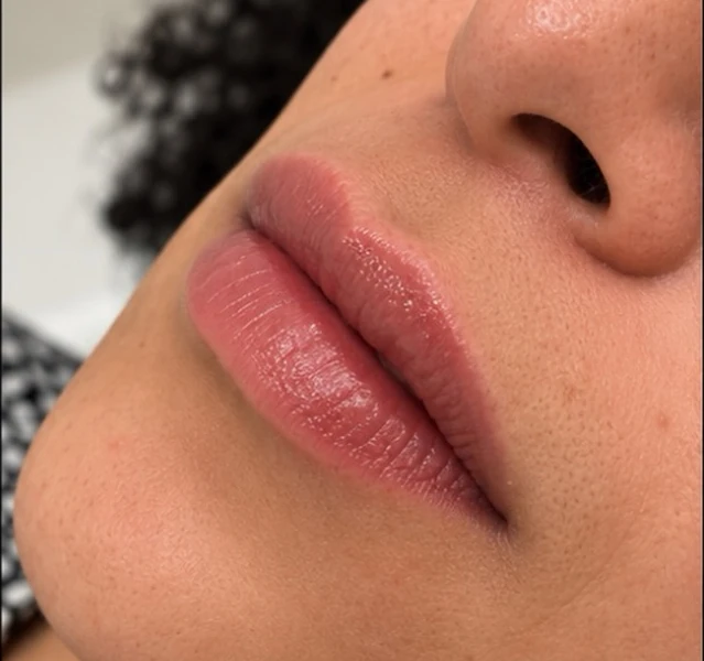 Região labial depois, no mesmo enquadramento.